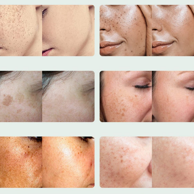 Suero Facial 5 en 1 con Colágeno y Ácido Hialurónico