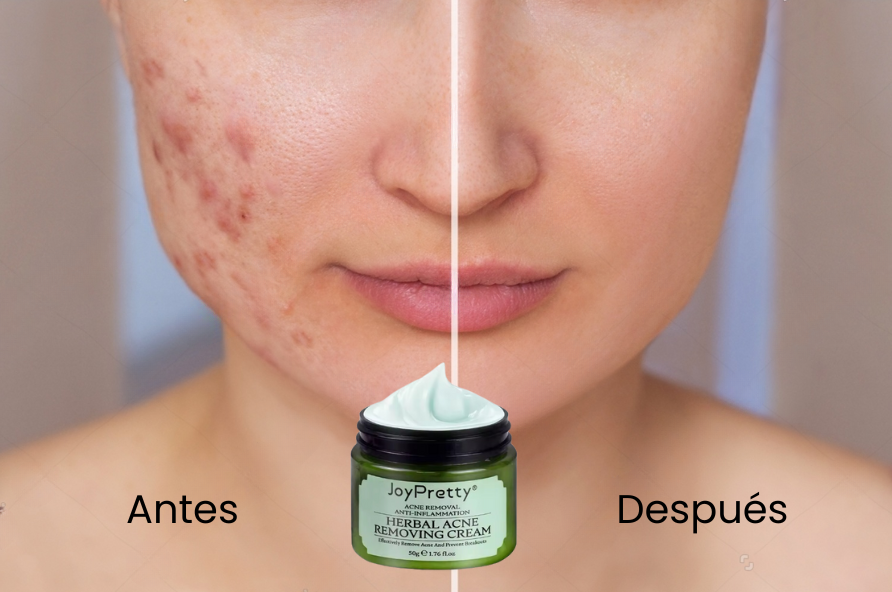 Crema Antiacné