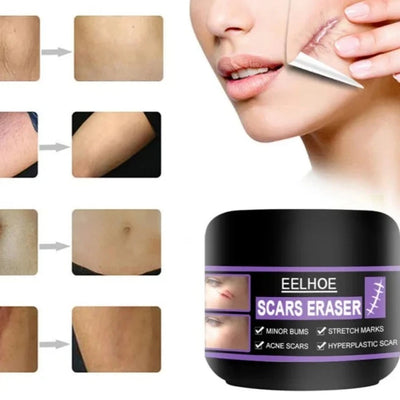 Magical Scar Removal Cream