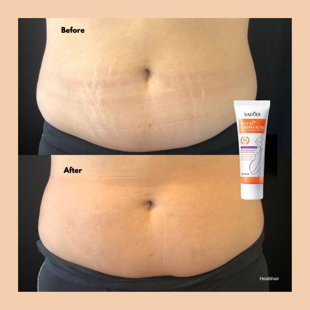 Stretch Marks Removal Cream