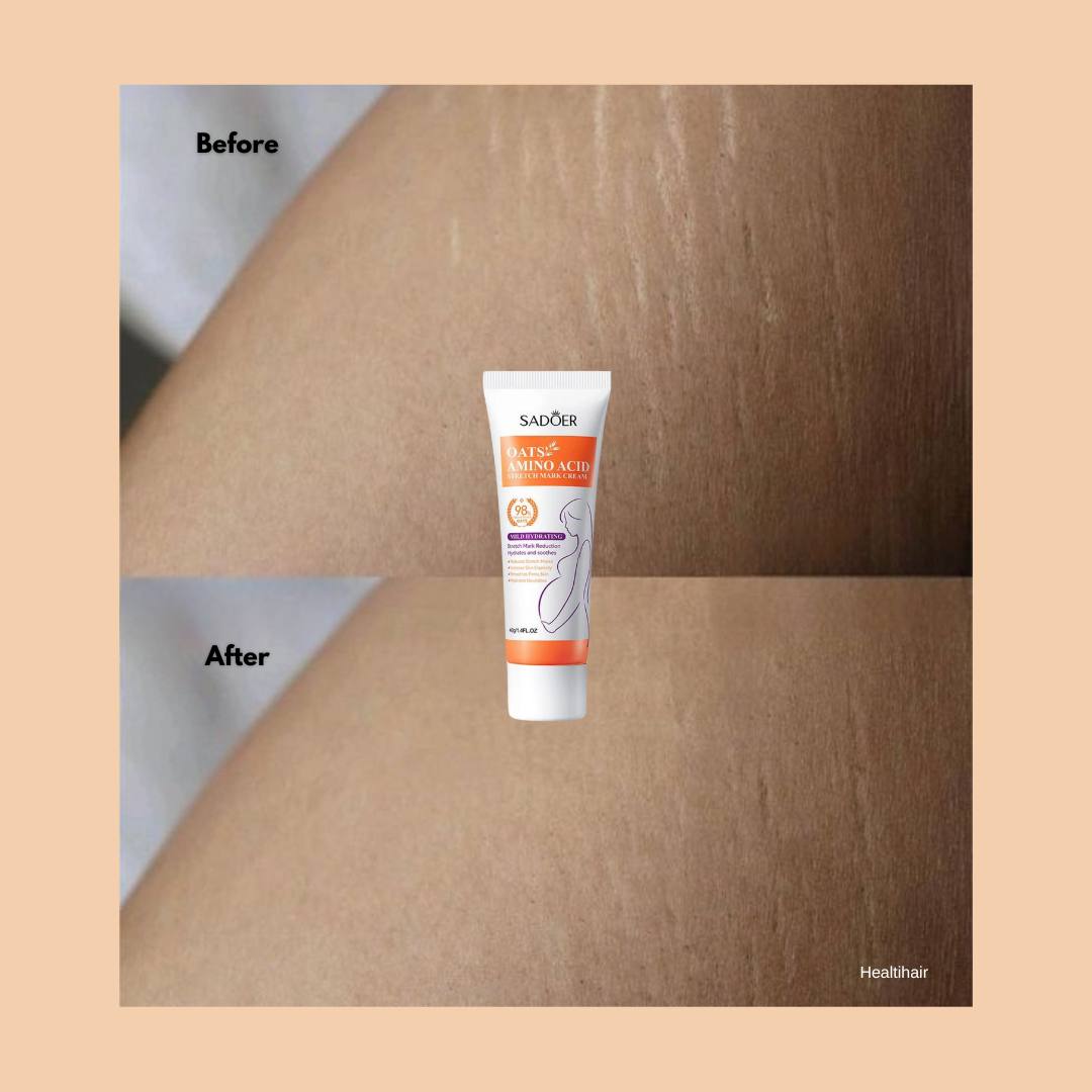 Stretch Marks Removal Cream