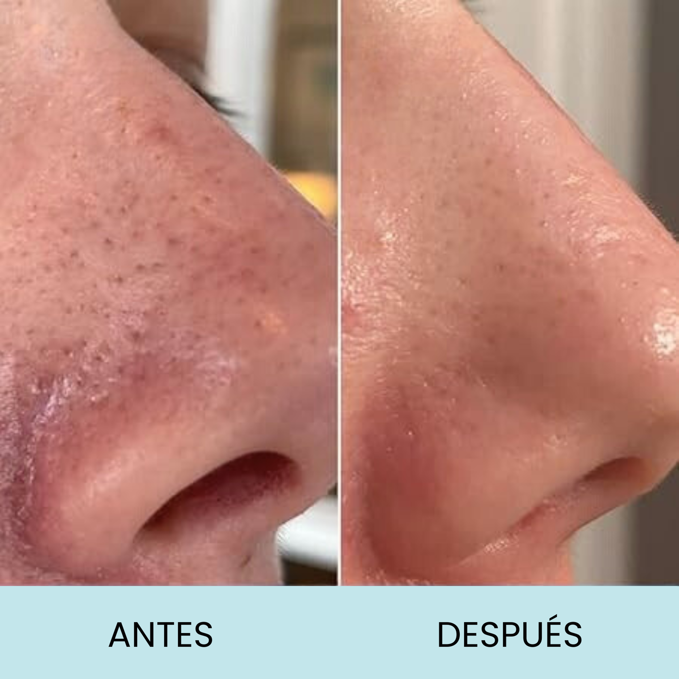Blackhead Control