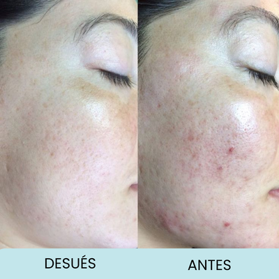 Blackhead Control