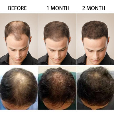 Hair Loss Treatment Shampoo