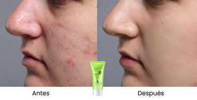 Acne Cream